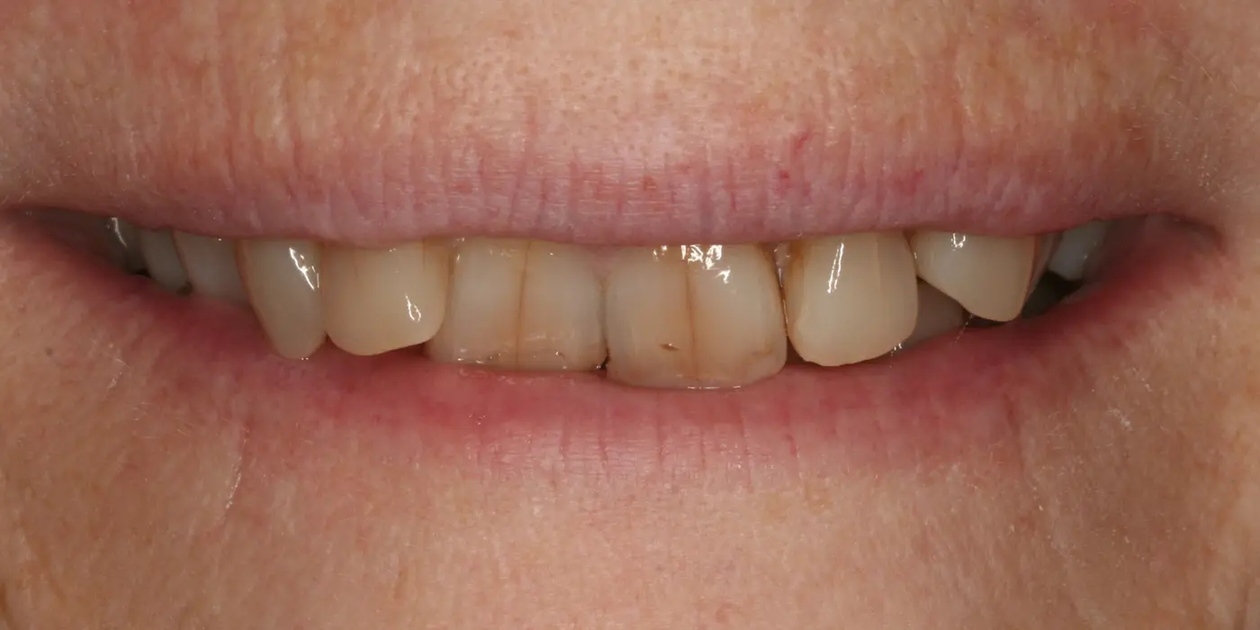 http://Smile%20Makeovers%20Before