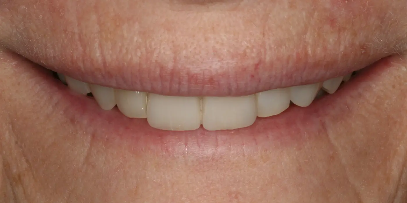 http://Smile%20Makeovers%20After