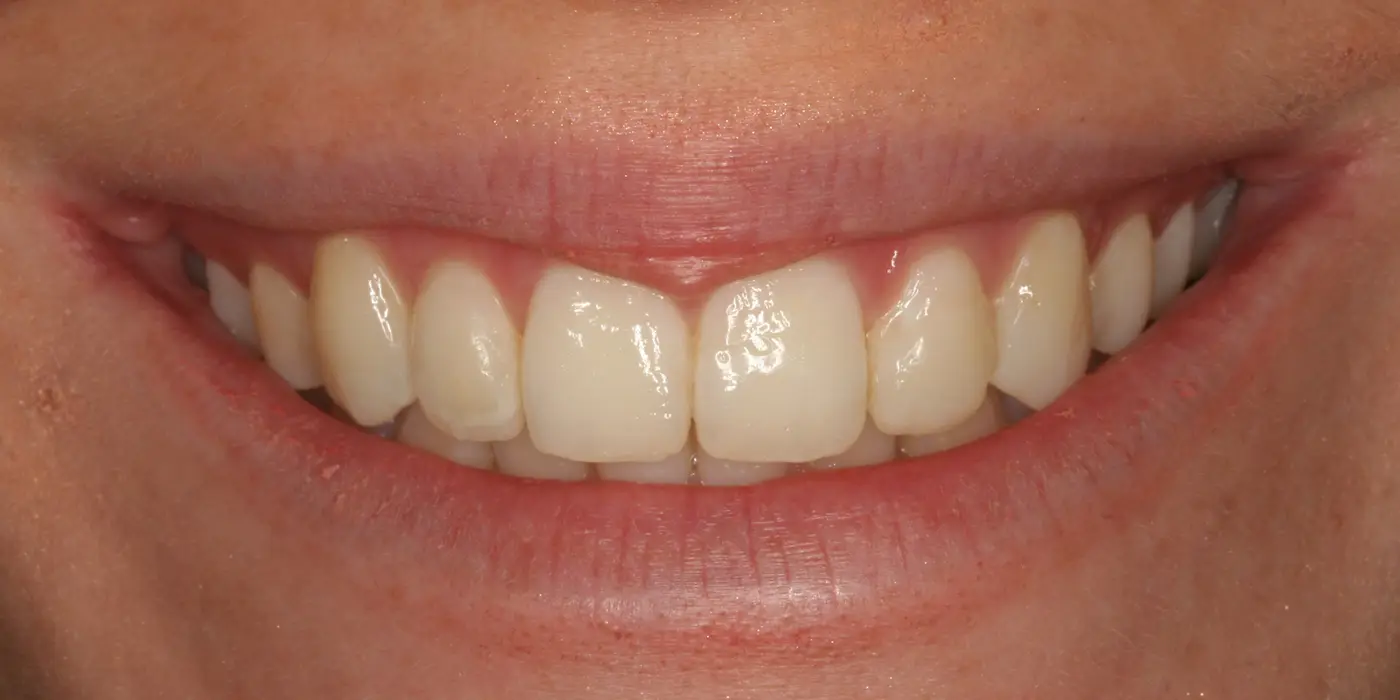 http://Smile%20Makeovers%20After