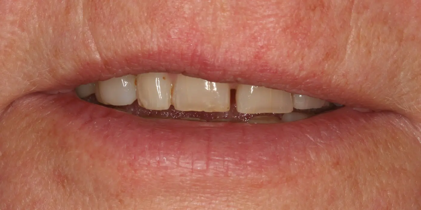 http://Composite%20bonding%20before