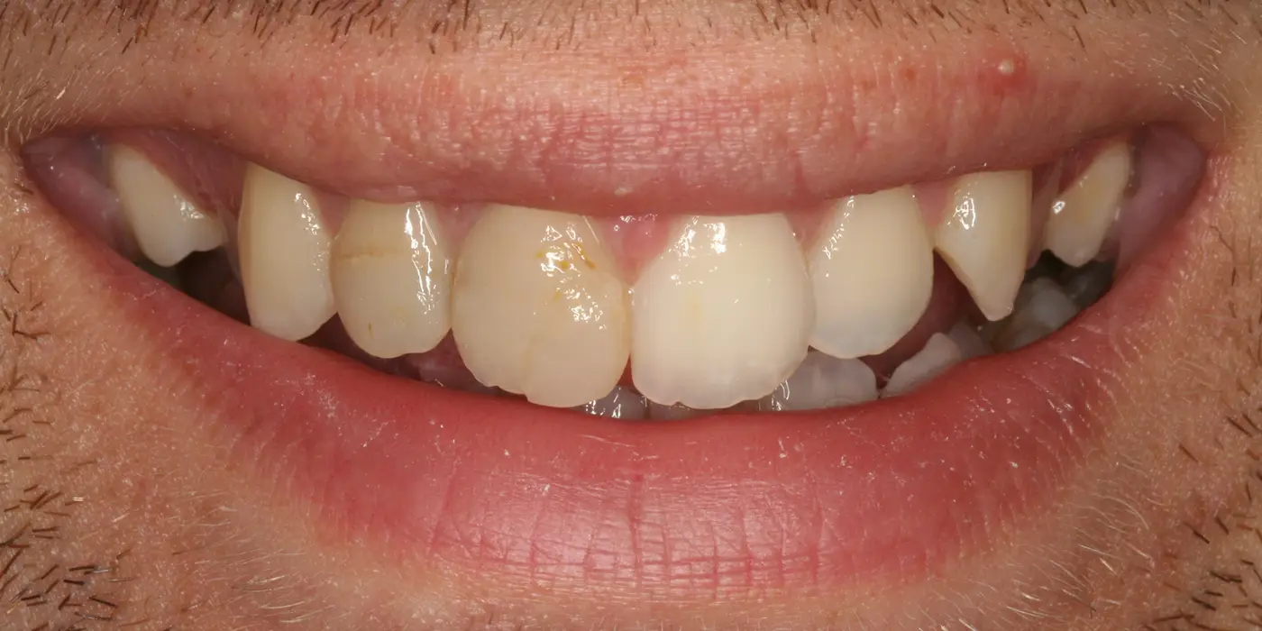 http://Veneers%20before