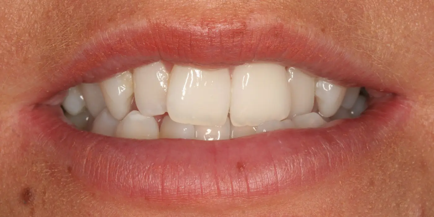 http://Invisalign%20Before