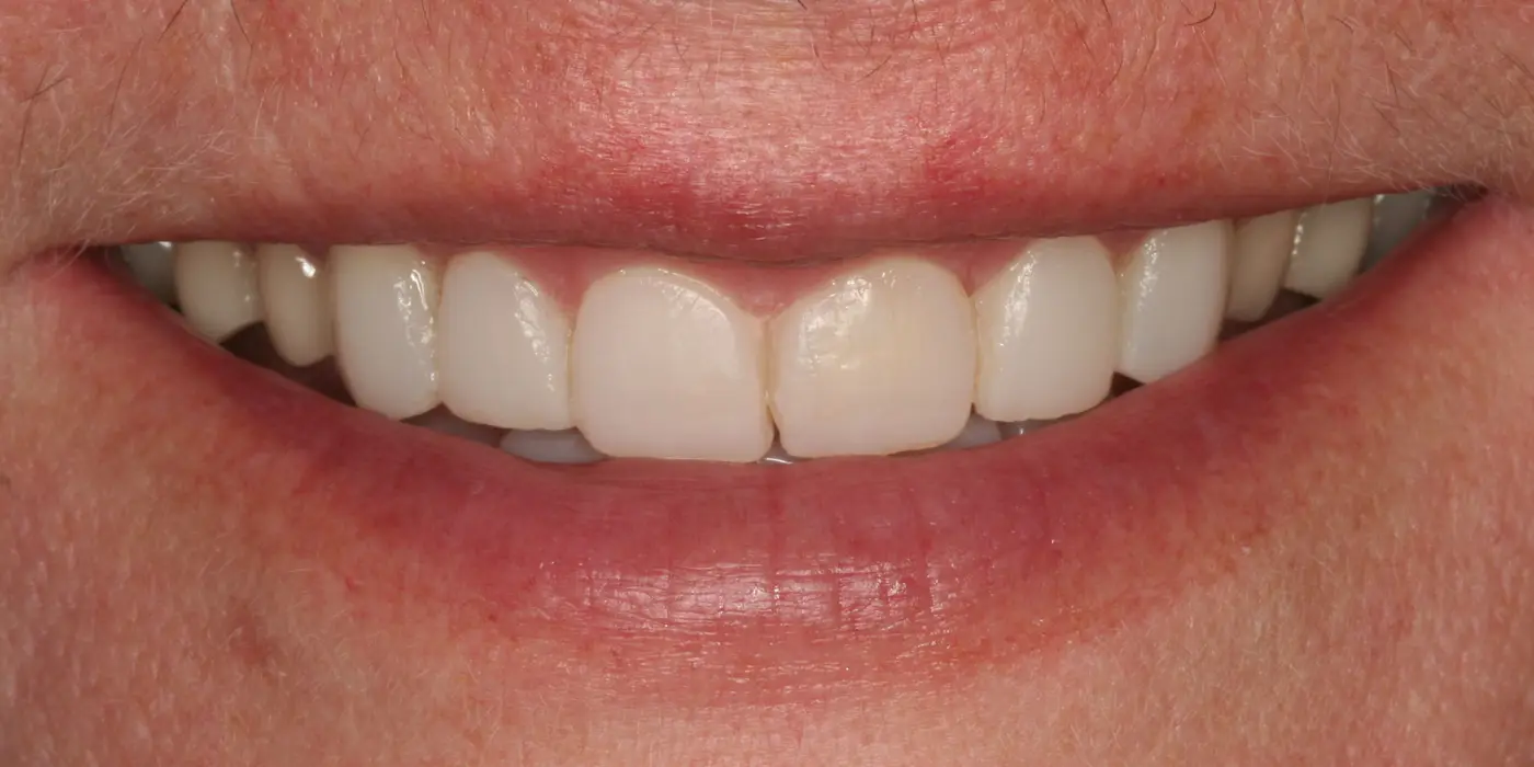 http://Composite%20bonding%20after